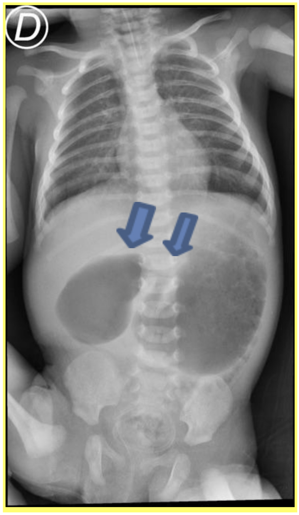 C:\Users\Ryyu\Downloads\imagen atresia duodenal.jpg